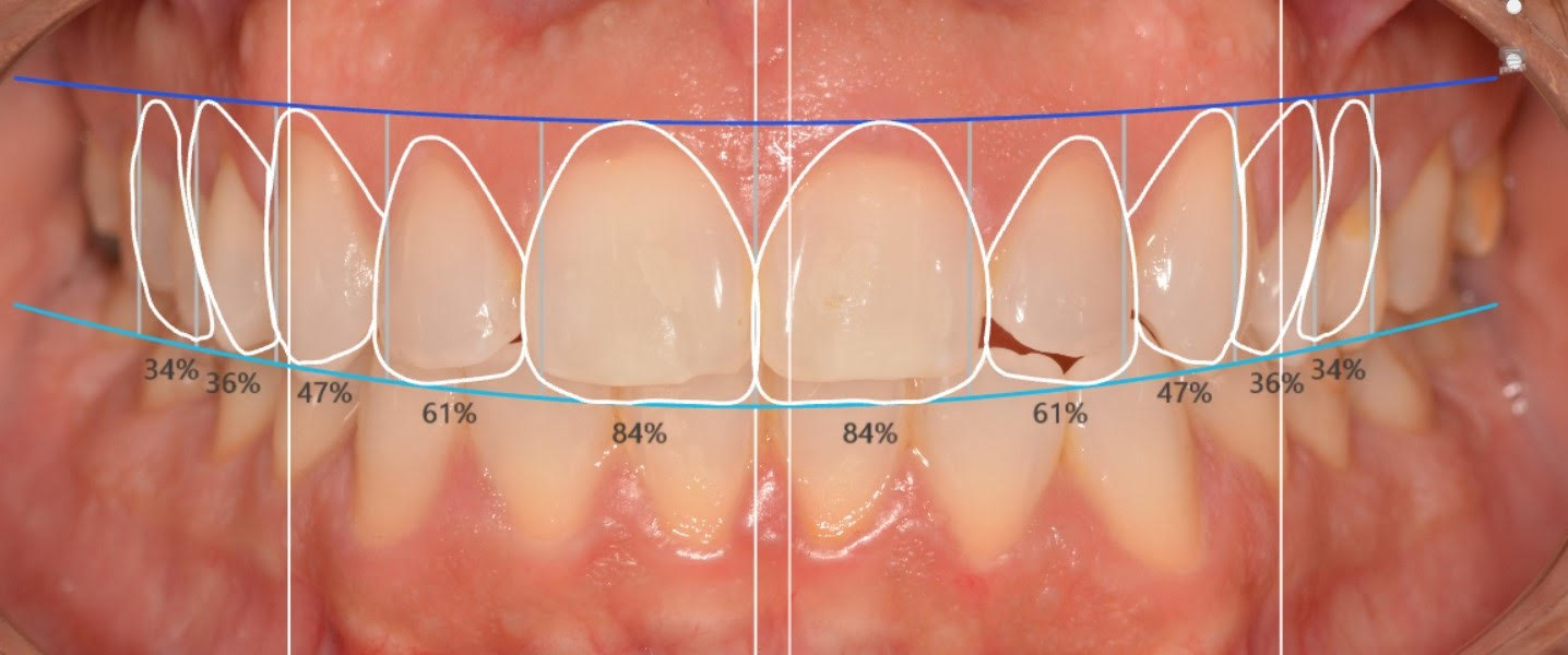 Smile design image of teeth